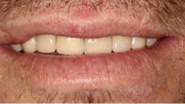 Gorgeous smile after repairing damaged top front teeth