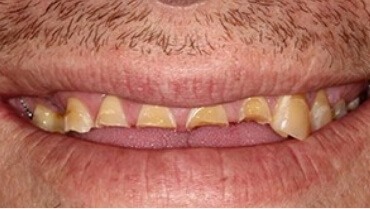 Smile with severely decayed and damaged top front teeth