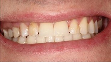 Imperfect smile before cosmetic dentistry