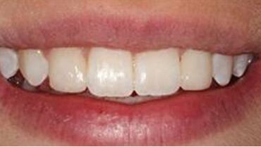 Smile after gaps between teeth are closed