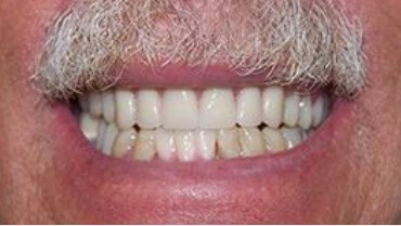 Whole healthy smile after restorative dentistry