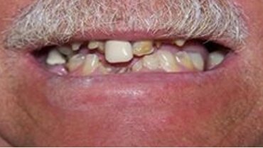 Damaged decayed and missing teeth before restorative dentistry