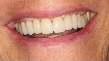 Beautiful smile with new dental restoration