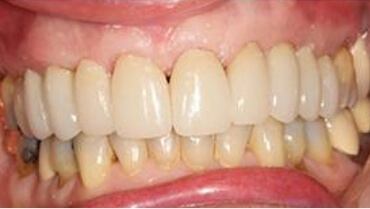 Closeup of smile with new more natural looking dental restoration