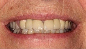 Brilliant perfect smile after cosmetic dentistry