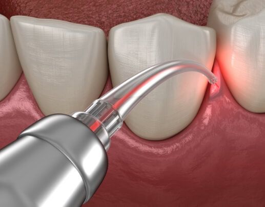 Animated smile during gum recontouring for gummy smile