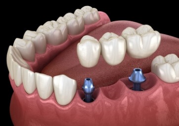 Animated smile showing the parts of dental implants