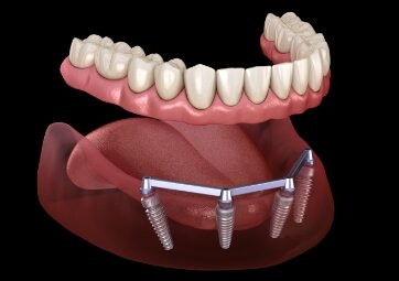 Animated dental implant denture with unique dental implant posts