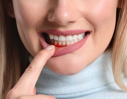 Dental patient with inflamed gums before periodontal therapy