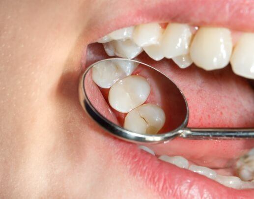 Dentist examining smile after dental sealant and fluoride treatment