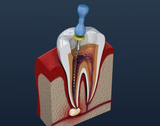 Animated tooth during root canal therapy