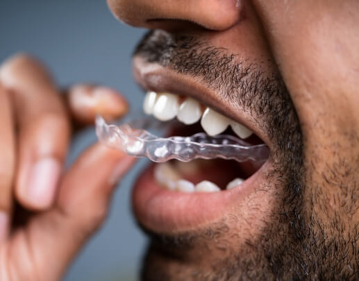 Dental patient placing Sure Smile clear aligner