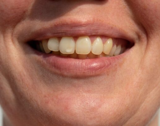 Closeup of smile of dental discoloration