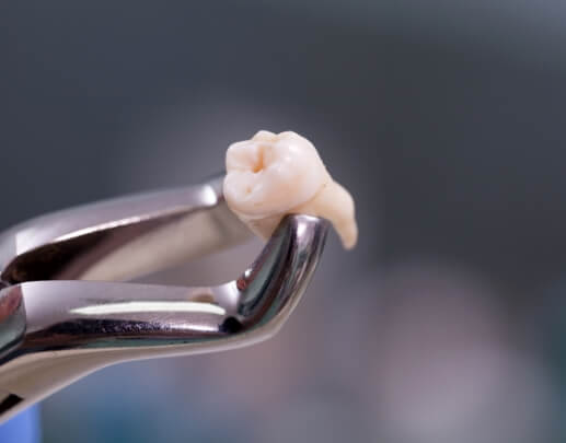 Metal clasp holding a tooth after extraction
