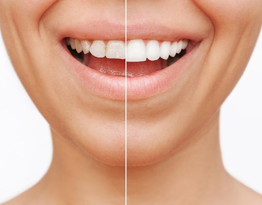 Closeup of patient's smile before and after veneers